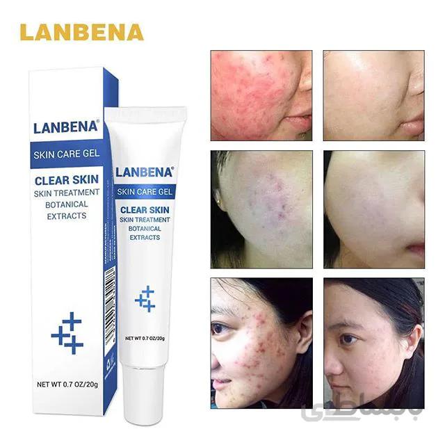ژل ضد جوش لانبنا ا Skin Care Gel
