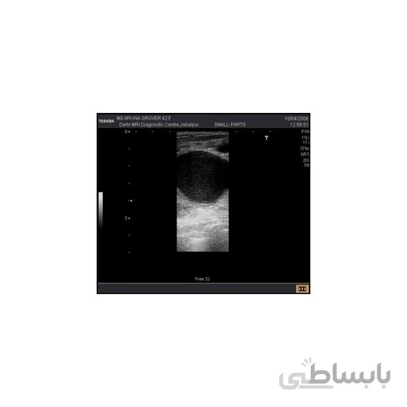کاهش نویز Speckle در تصاویر سونوگرافی در MATLAB
