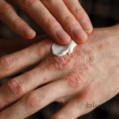 کرم ضد پسوریازیس قوی(بالک)