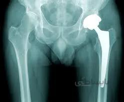 استئومالیت حاد و آرتریت سپتیک در کودکان(اصل مقاله ترجمه و پروپزال) - صدتو