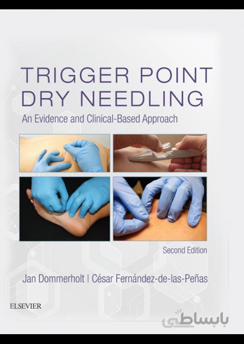 Trigger Point Dry Needling