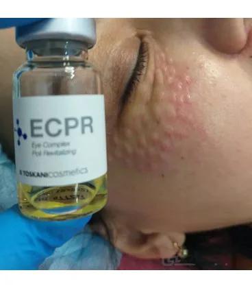 کوکتل میکرونیدلینگ دور چشم توسکانی TOSKANI ECPR