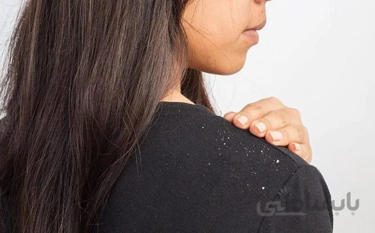 پکیج ضد شوره موی سر