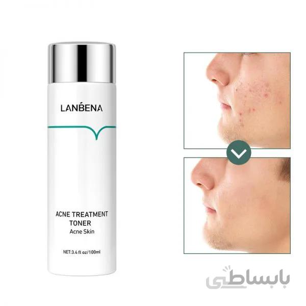 تونر ضد آکنه و جوش لانبنا lanbena