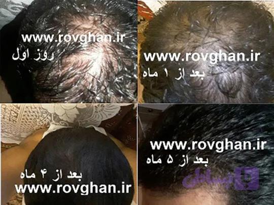 پک ضد ریزش مو