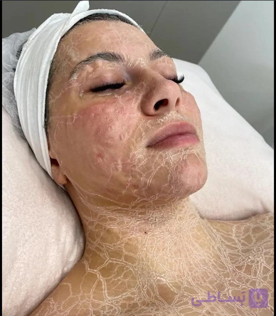دوره آموزشی شبه بوتاکس(پپتایدتراپی)