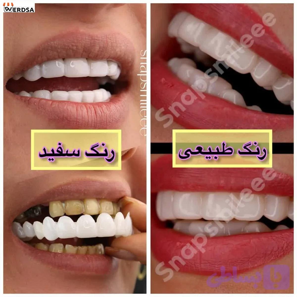 لمینت دندان true smile خمیر درشت