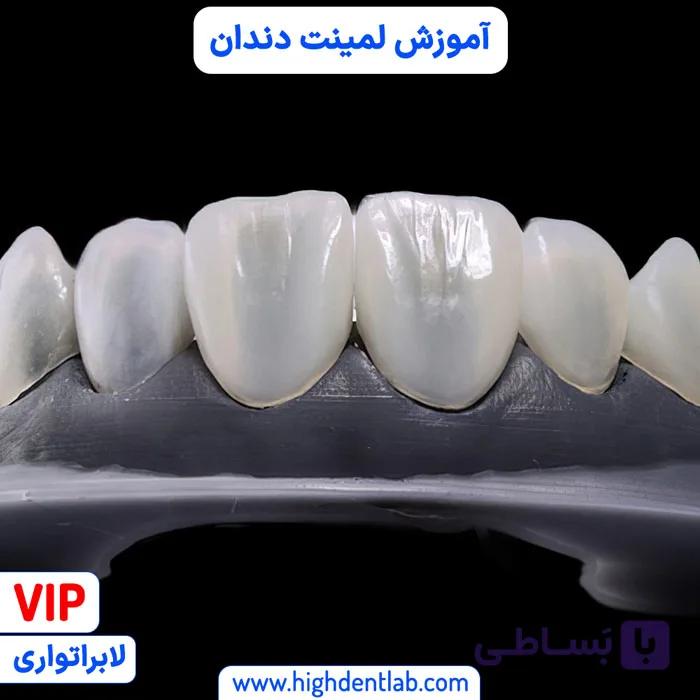 آموزش لمینت دندان — تصویر 1