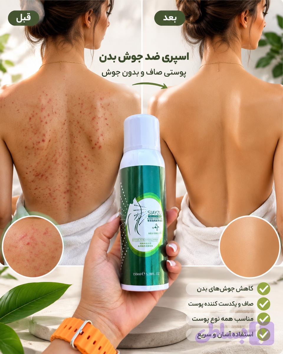 اسپری ضد جوش قوی و سریع‌اثر | مناسب جوش صورت و بدن | کمک به کاهش التهاب و قرمزی جوش
